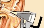 Zewnętrzny kanał słuchowy i bębenek mogą być odpowiednio oświetlone i zbadane.