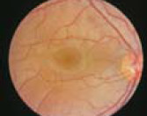 Obraz z Filtr polaryzacyjnego oftalmoskopu riester
