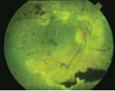 Obraz z Filtr zielonego oftalmoskopu riester